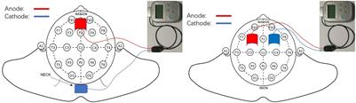 Transcranial Direct Current Stimulation Over Prefrontal Areas Improves Psychomotor Inhibition State in Patients With Traumatic Brain Injury: A Pilot Study